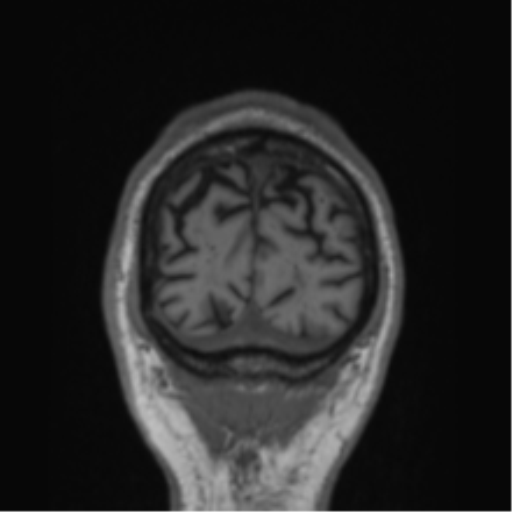 Alzheimer's disease- with Gerstmann syndrome and dressing apraxia (Radiopaedia 54882-61150 Coronal T1 9).png