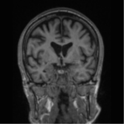 File:Alzheimer's disease- with apraxia (Radiopaedia 54763-61011 Coronal T1 56).png