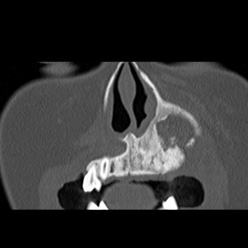 File:Ameloblastic fibro-odontoma (Radiopaedia 18843-18780 B 6).jpg