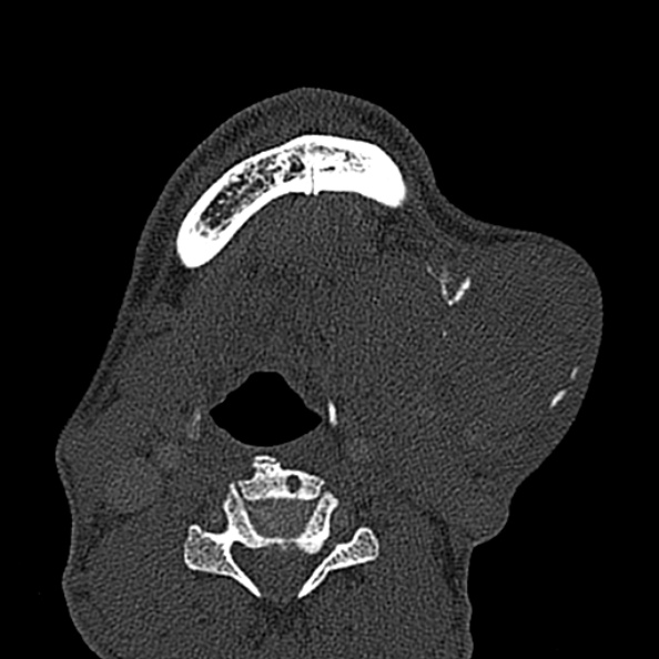 Ameloblastoma (Radiopaedia 51921-57766 Axial bone window 29).jpg