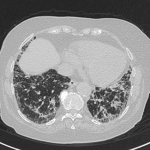 Amiodarone-induced pulmonary fibrosis (Radiopaedia 82355-96460 Axial lung window 51).jpg