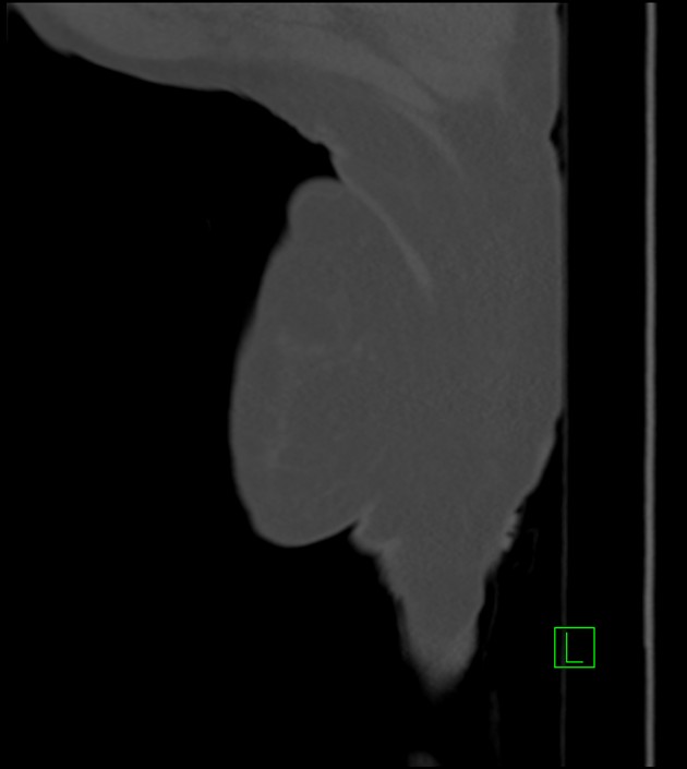Amiodarone deposition in the liver (Radiopaedia 77587-89780 Sagittal bone window 101).jpg