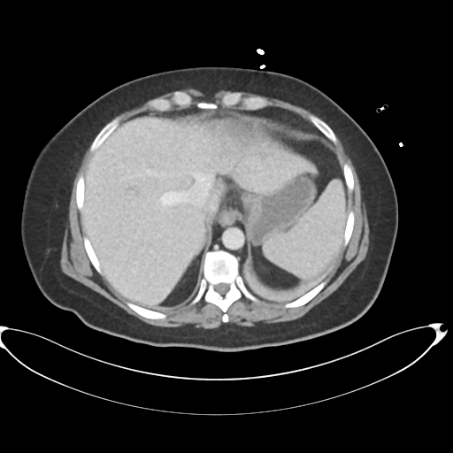 File:Amoebic liver abscess (Radiopaedia 52611-58530 A 16).png