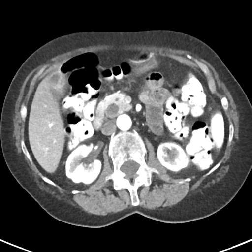 Ampullary adenocarcinoma (Radiopaedia 34013-35237 B 37).png