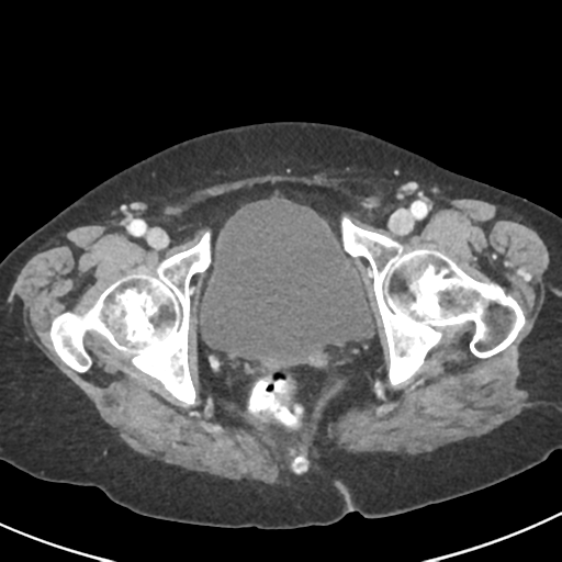 Ampullary adenocarcinoma (Radiopaedia 34013-35237 C 55).png