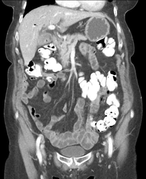 Ampullary adenocarcinoma (Radiopaedia 34013-35237 E 20).png