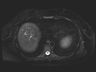 Ampullary adenocarcinoma (Radiopaedia 54765-61014 Axial T2 space-FS 8).jpg