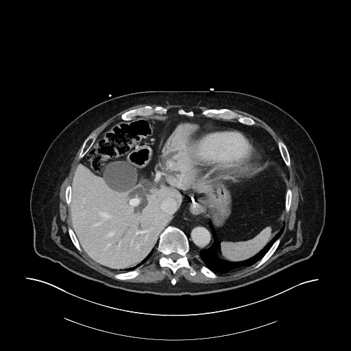 Ampullary adenocarcinoma (Radiopaedia 59373-66734 C 34).jpg