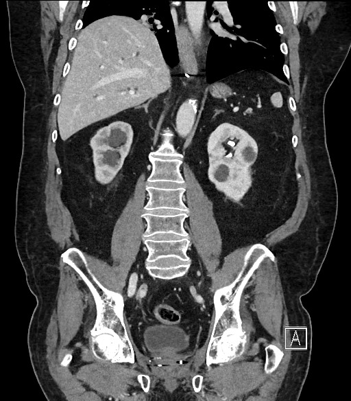 Ampullary adenocarcinoma (Radiopaedia 59373-66734 D 70).jpg