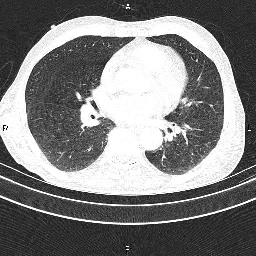 Ampullary adenocarcinoma (Radiopaedia 86093-102033 Axial lung window 36).jpg