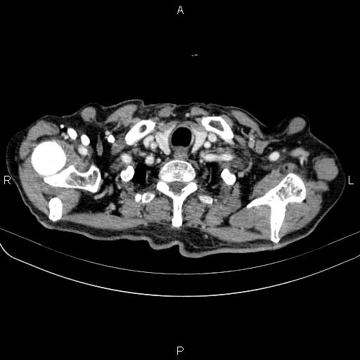 Ampullary adenocarcinoma (Radiopaedia 86093-102033 B 12).jpg