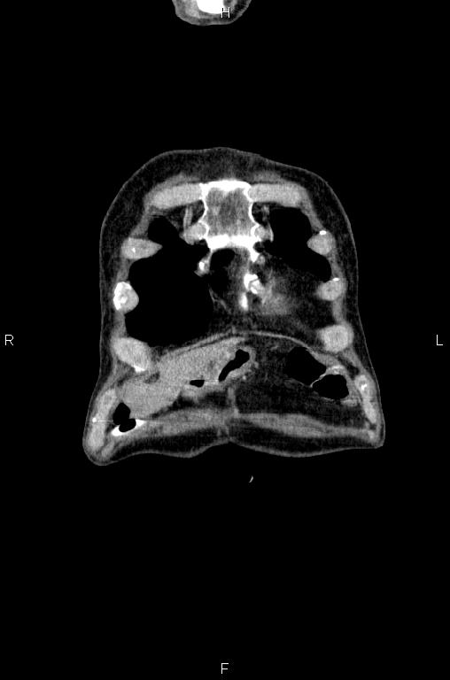 Ampullary adenocarcinoma (Radiopaedia 86093-102033 D 1).jpg