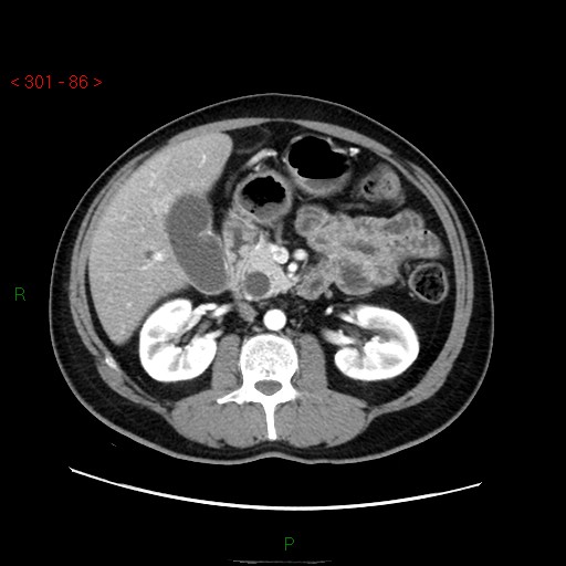 File:Ampullary carcinoma (Radiopaedia 56396-63056 B 32).jpg
