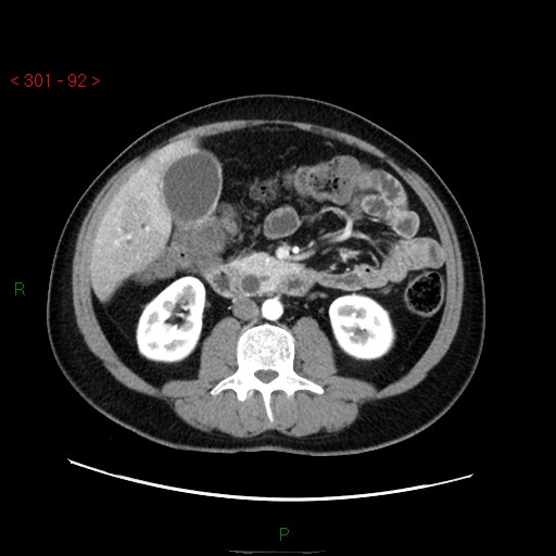 File:Ampullary carcinoma (Radiopaedia 56396-63056 B 38).jpg