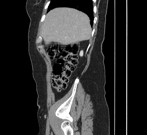 File:Ampullary tumor (Radiopaedia 60333-67998 C 7).jpg