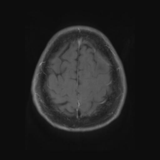 File:Amyloid angiopathy with inflammation (Radiopaedia 30360-31002 Axial T1 C+ fat sat 28).jpg