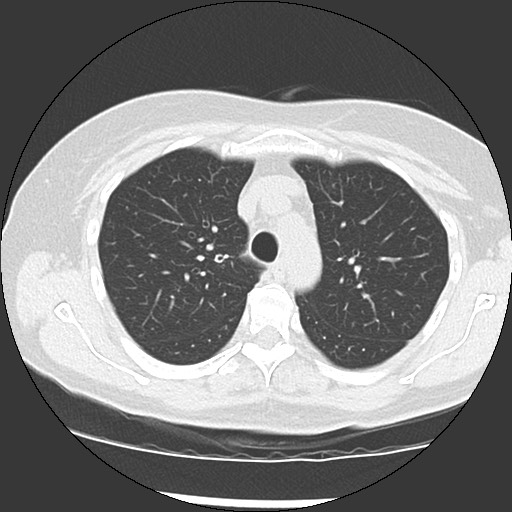 Amyloidosis - bronchial and diffuse nodular pulmonary involvement (Radiopaedia 60156-67744 B 17).jpg