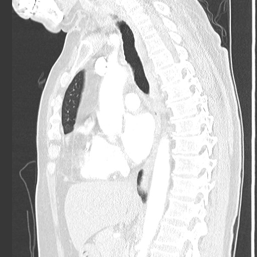 Amyloidosis - bronchial and diffuse nodular pulmonary involvement (Radiopaedia 60156-67745 Sagittal lung window 46).jpg