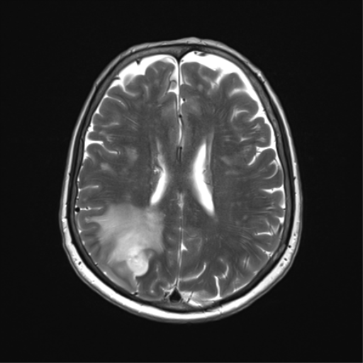 File:Anaplastic astrocytoma (Radiopaedia 86943-103160 Axial T2 25).png