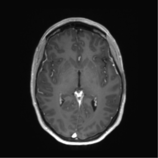 File:Anaplastic astrocytoma IDH mutant (Radiopaedia 50046-55341 Axial T1 C+ 25).png