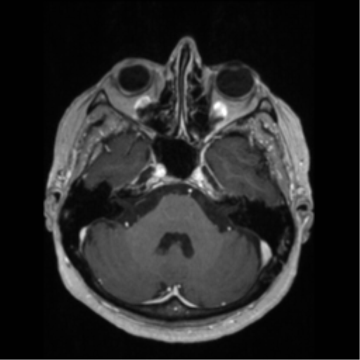 File:Anaplastic astrocytoma IDH wild-type (pseudoprogression) (Radiopaedia 42209-45276 Axial T1 C+ 44).png