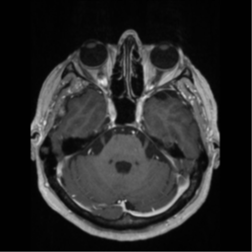 File:Anaplastic astrocytoma IDH wild-type (pseudoprogression) (Radiopaedia 42209-45276 Axial T1 C+ 49).png