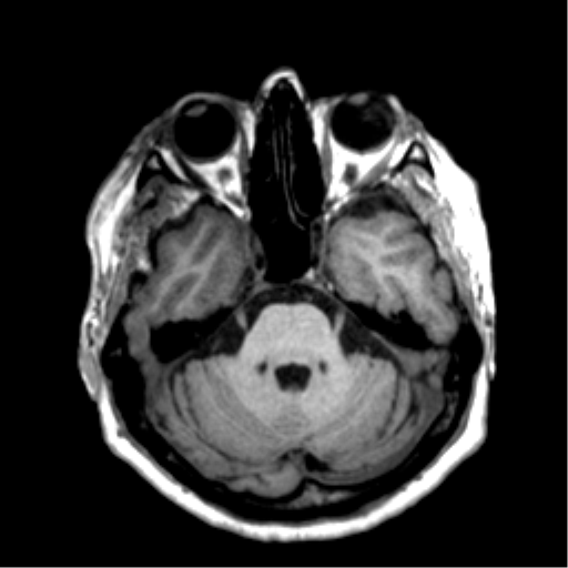 Anaplastic astrocytoma IDH wild-type (pseudoprogression) (Radiopaedia 42209-45277 Axial T1 39).png