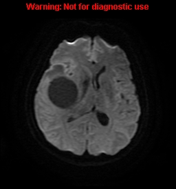 File:Anaplastic ganglioglioma (Radiopaedia 44921-48831 Axial DWI 16).jpg