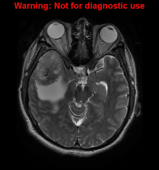 File:Anaplastic ganglioglioma (Radiopaedia 44921-48831 Axial T2 12).jpg
