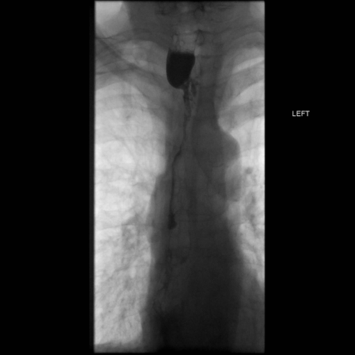 File:Anastomotic stricture post Ivor Lewis esophagectomy (Radiopaedia 47937-52715 B 23).png