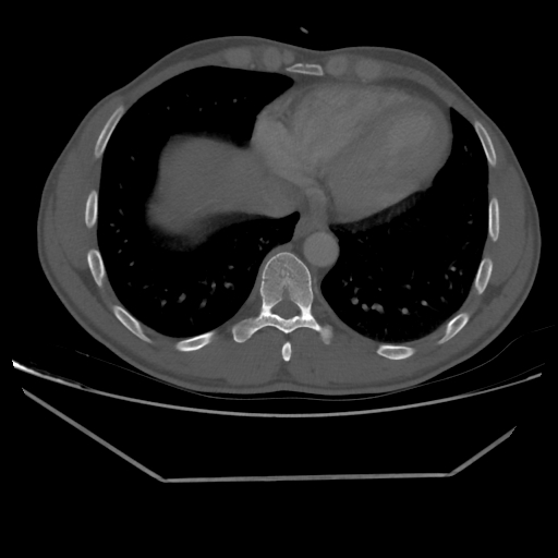 Aneurysmal bone cyst - rib (Radiopaedia 82167-96220 Axial bone window 190).jpg