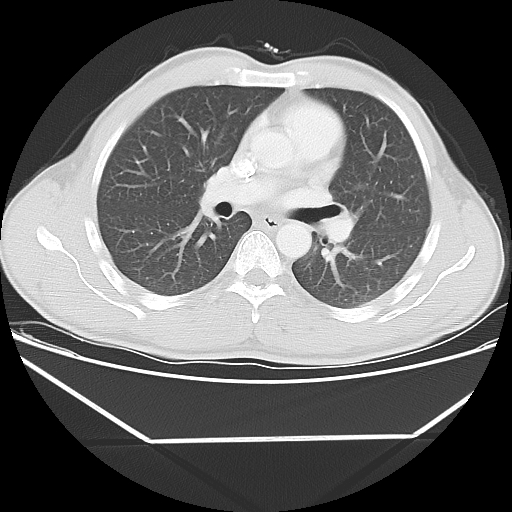 File:Aneurysmal bone cyst - rib (Radiopaedia 82167-96220 Axial lung window 33).jpg
