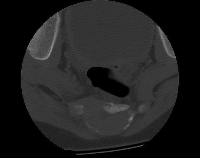 Aneurysmal bone cyst - sacrum (Radiopaedia 65190-74195 Axial bone window 37).jpg