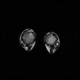 File:Aneurysmal bone cyst - tibia (Radiopaedia 22343-22367 Axial T2 15).jpg
