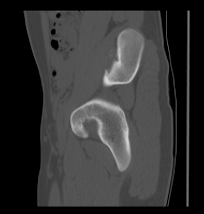 Aneurysmal bone cyst of ischium (Radiopaedia 25957-26094 Sagittal bone window 24).png