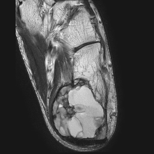 File:Aneurysmal bone cyst of the calcaneus (Radiopaedia 60669-68420 Axial T2 9).jpg
