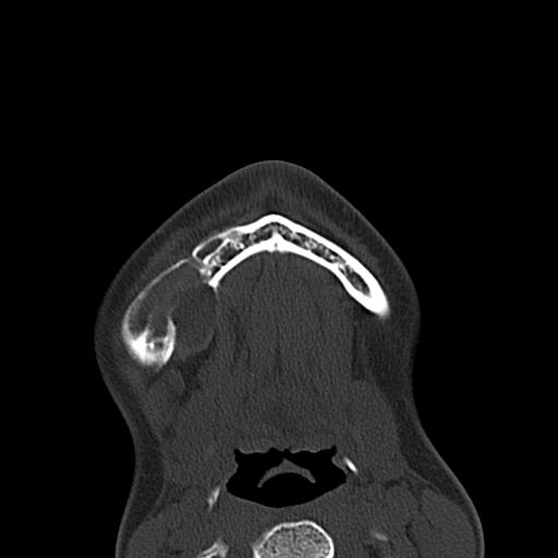 Aneurysmal bone cyst of the mandible (Radiopaedia 43280-46601 Axial bone window 7).jpg
