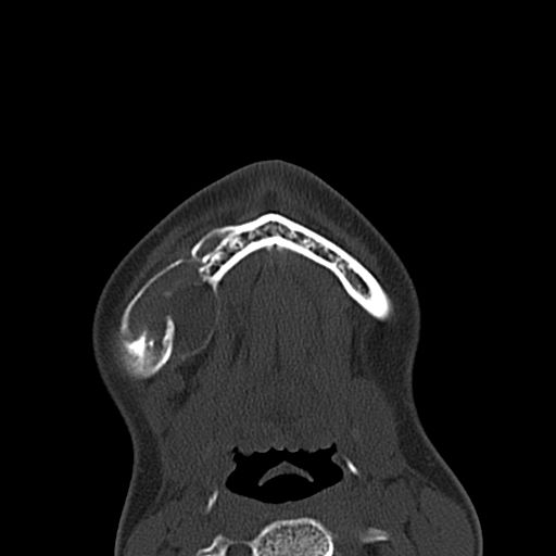 Aneurysmal bone cyst of the mandible (Radiopaedia 43280-46601 Axial bone window 8).jpg
