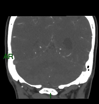Aneurysmal subarachnoid hemorrhage with intra-axial extension (Radiopaedia 84371-99732 C 32).jpg