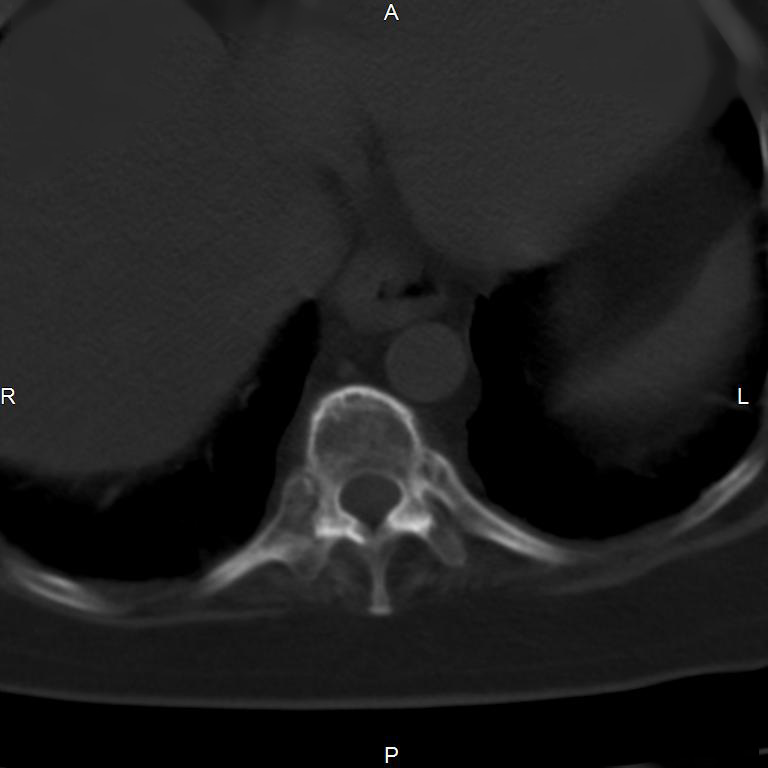 Ankylosing spondylitis (Radiopaedia 8748-9556 Axial bone window 5).jpg