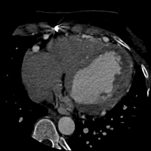 Anomalous left coronary artery from the pulmonary artery (ALCAPA) (Radiopaedia 40884-43586 A 55).jpg
