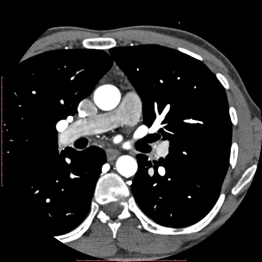 Anomalous left coronary artery from the pulmonary artery (ALCAPA) (Radiopaedia 70148-80181 A 9).jpg