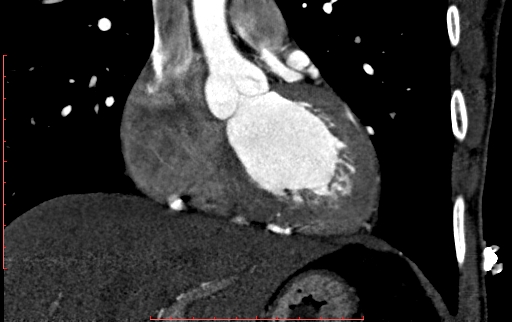 Anomalous left coronary artery from the pulmonary artery (ALCAPA) (Radiopaedia 70148-80181 B 140).jpg