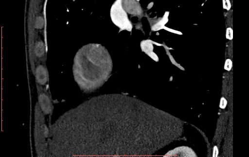 Anomalous left coronary artery from the pulmonary artery (ALCAPA) (Radiopaedia 70148-80181 C 10).jpg