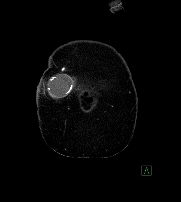 Anterior abdominal wall CSF pseudocyst (CSFoma) (Radiopaedia 79453-92571 B 8).jpg