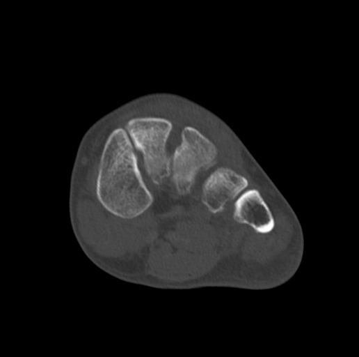 Anterior calcaneal process fracture (Radiopaedia 47384-51989 Coronal bone window 41).png