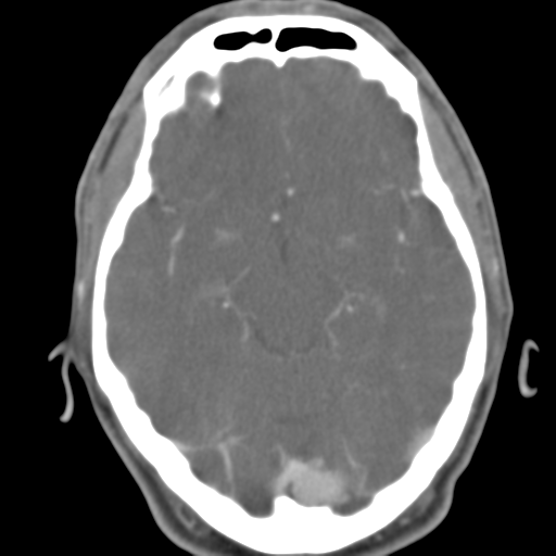 File:Anterior cerebral artery territory infarct (Radiopaedia 39327-41581 B 35).png