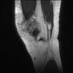 Anterior cruciate ligament rupture with Segond fracture (Radiopaedia 69043-78806 Sagittal PD 19).jpg