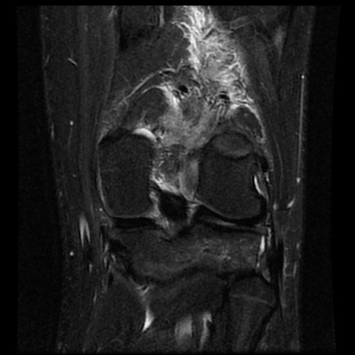 File:Anterior cruciate ligament tear (Radiopaedia 61500-69462 Coronal STIR 15).jpg