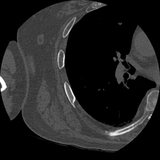 Anterior glenohumeral dislocation with Hill-Sachs lesion (Radiopaedia 62877-71249 Axial bone window 102).jpg